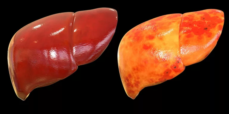 How to Transition from a Fatty Liver to a Healthy Liver with Ketosis?