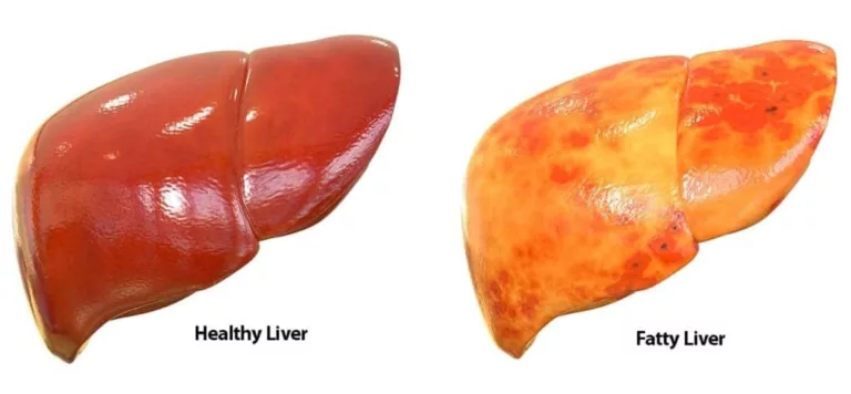 Transitioning from a Fatty Liver to a Healthy Liver in Ketosis: How Long Does It Take?